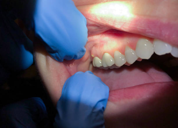 Best Emergency Dental Care for Broken or Chipped Teeth in Fort Bliss, TX